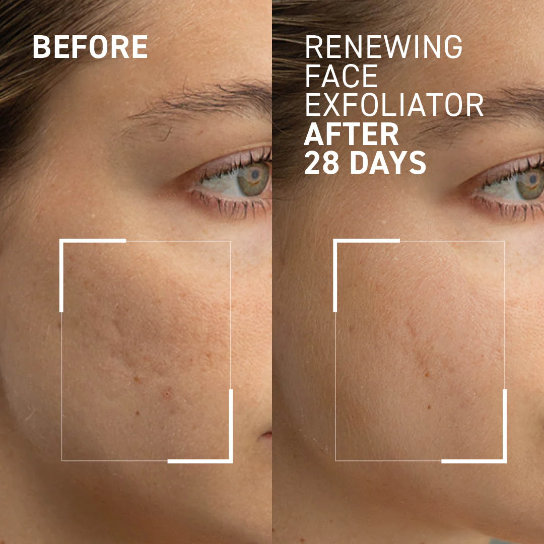Gentle Microdermabrasion Face Exfoliator - Image 3