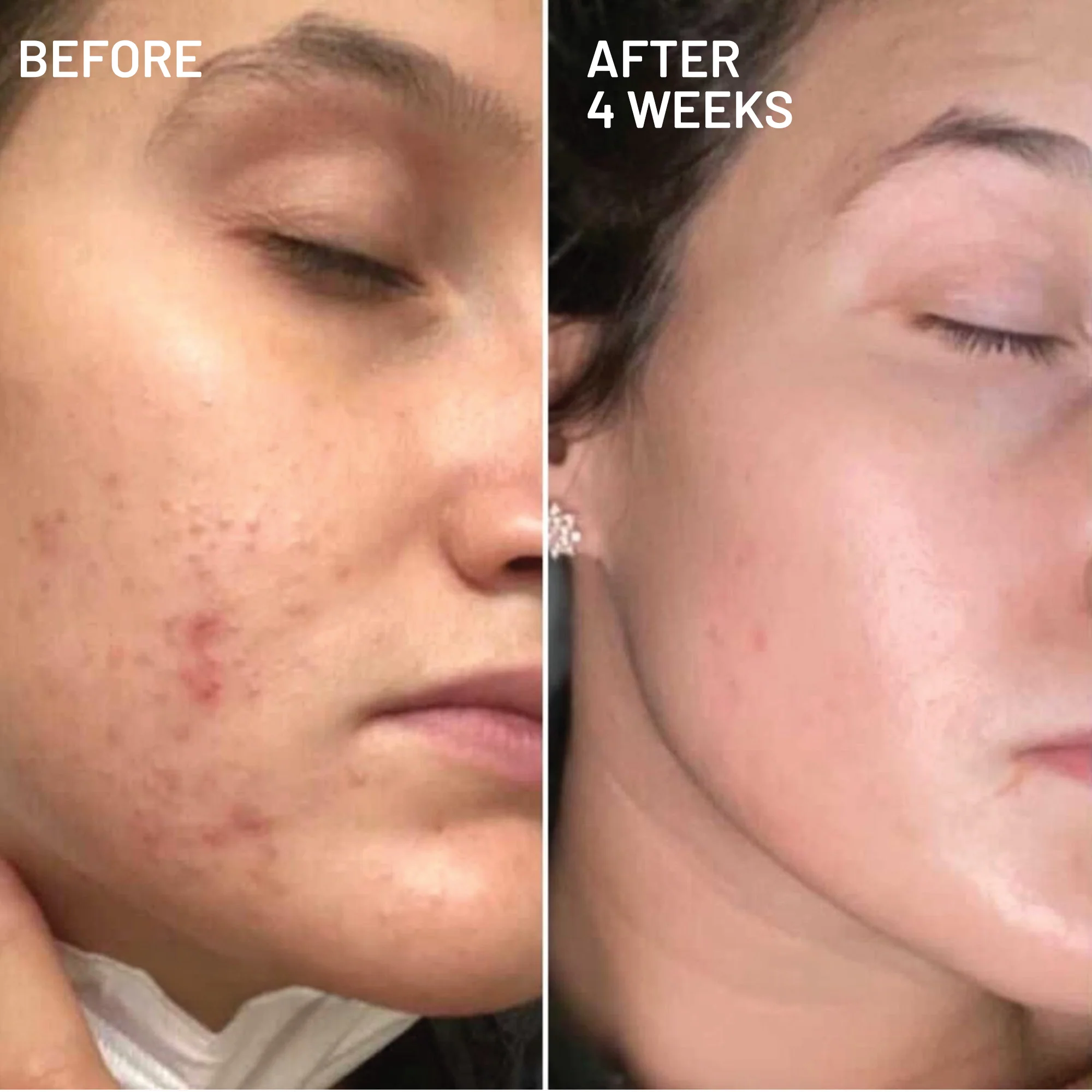 Hyperpigmentation & Melasma Routine - Image 5