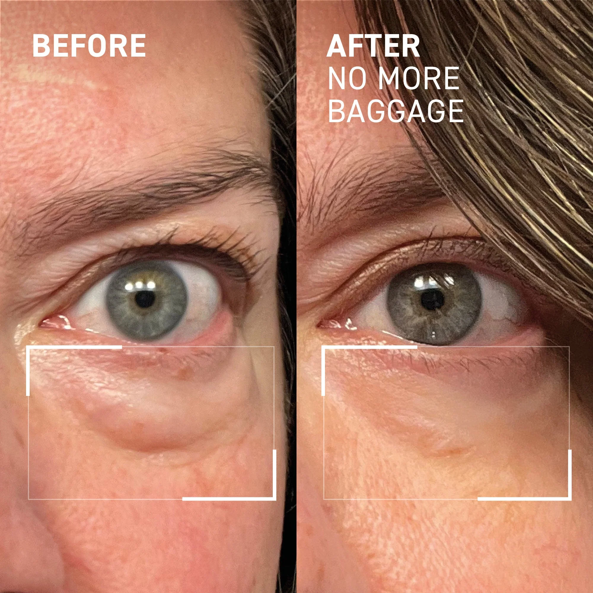 Needles No More No More Baggage Eye Gel 7g - Image 4